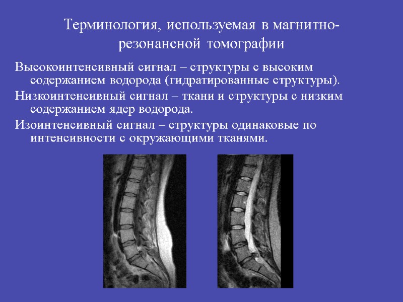 Терминология, используемая в магнитно-резонансной томографии Высокоинтенсивный сигнал – структуры с высоким содержанием водорода (гидратированные